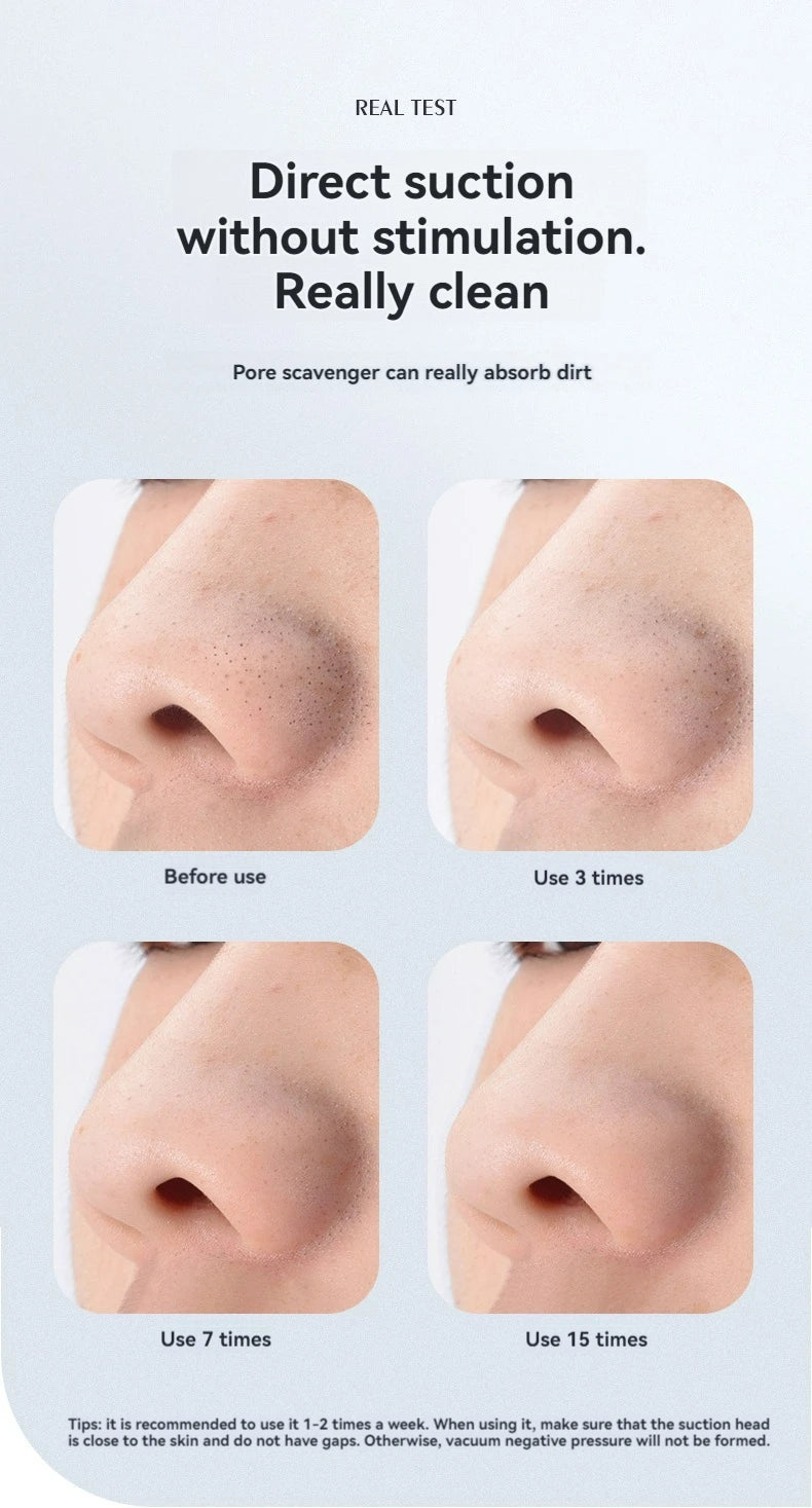 DYOX Portable Blackhead Remover